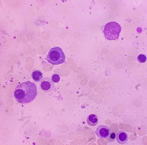 ide-cel multiple myeloma